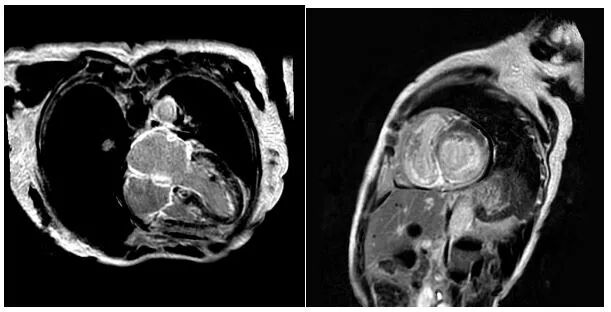 d-spect怎么检查厦门大学附属心血管病医院应用D-SPECT筛查出突变型心肌淀粉样变家系_https://www.jmylbn.com_新闻资讯_第5张