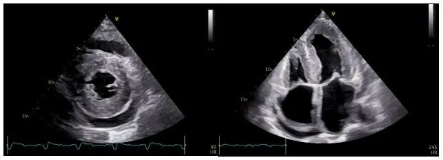 d-spect怎么检查厦门大学附属心血管病医院应用D-SPECT筛查出突变型心肌淀粉样变家系_https://www.jmylbn.com_新闻资讯_第3张