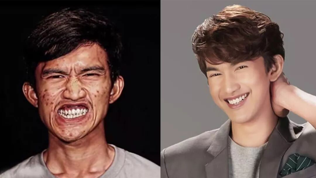 奇聞 泰國男子因長得太醜 整天躲在家裡哭 整容後變成花美男 Justyou