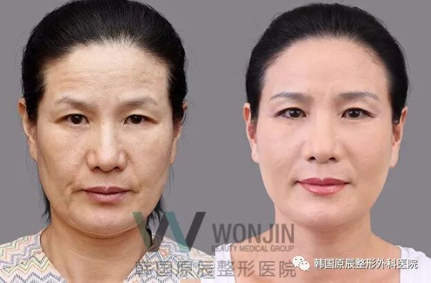 原辰拉皮提升让时间不再是女人的对手