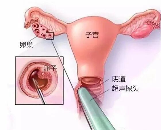 取卵针长什么样害怕，一根取卵针竟然这么长长长长！得多疼啊！无痛取卵了解一下。_https://www.jmylbn.com_新闻资讯_第3张