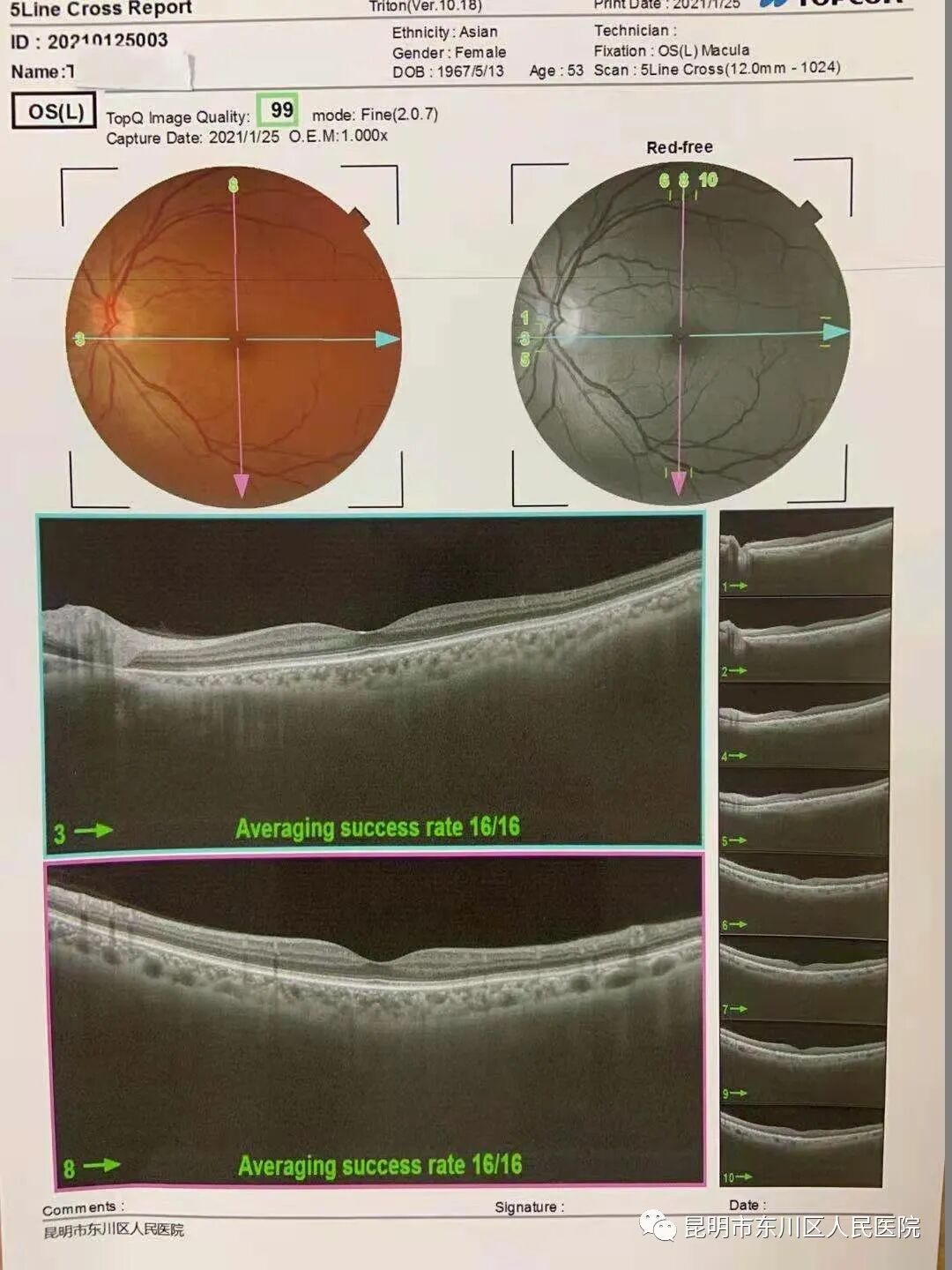 学科发展 昆明市东川人民医院眼科引进无创检查新设备oct 医院新闻 昆明市东川区人民医院