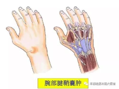 導致手腕關節滑膜腔的損傷,從而引發腱鞘囊腫