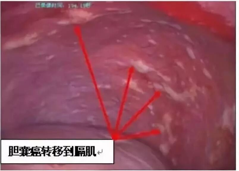 胆囊结石久拖不治的六种危害