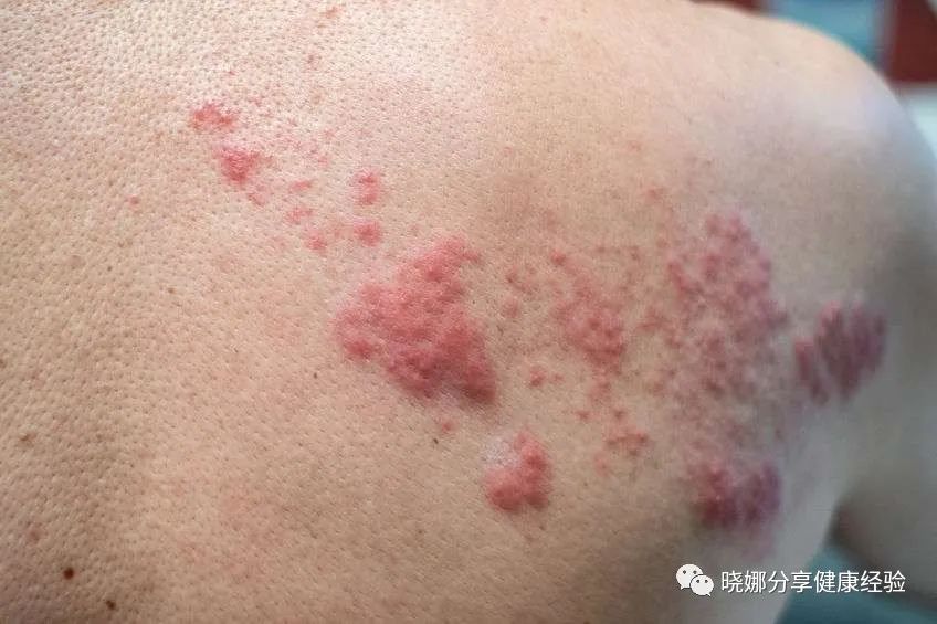 一旦患上带状疱疹，会有哪些症状？第一、瘙痒带状疱疹本身是由其对应的
