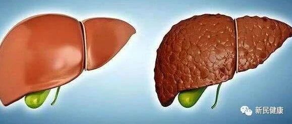 肝脏硬化，皮肤告知？提醒：皮肤出现这种痣，暗示肝硬化即将到来【新民健康】