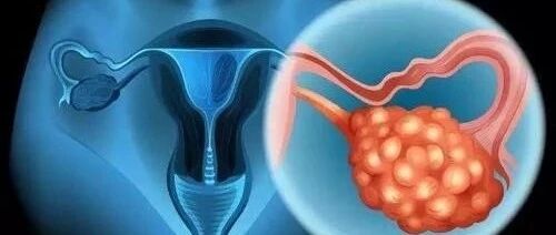 卵巢癌的4个重要早期信号，早点发现，还有机会治疗！【新民健康】