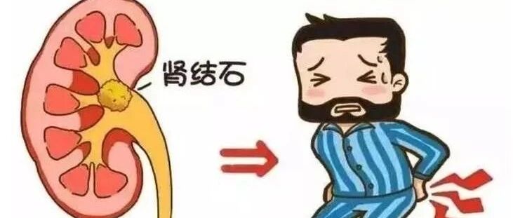 结石可能是你一口口“吃”出来的！专家点明：4种吃法易长结石【新民健康】