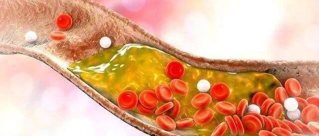 眼部出现这4种现象，可能在提醒你：血脂已偏高【新民健康】