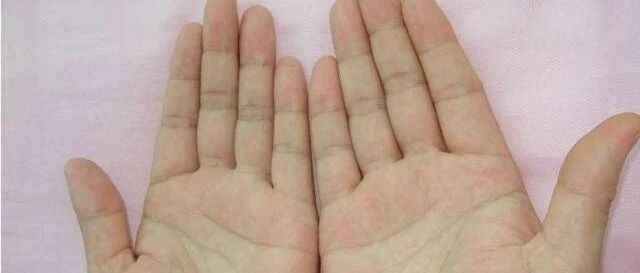 体内有癌，手往往有2种异常，如果全占，尽快排查这种癌症！【新民健康】