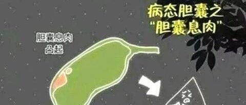 体检发现胆囊息肉怎么办？以下几种情况警惕息肉癌变【新民健康】