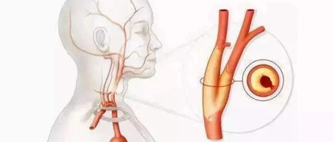 2亿中国人颈动脉“长斑”？4件事若还不纠正，斑块或许会越长越大【新民健康】