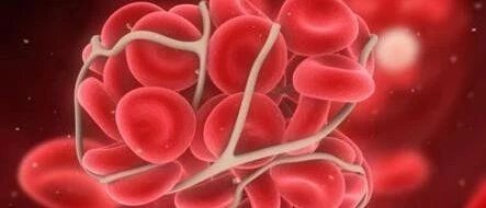 七类人需要重点防血栓 预防血栓怎么做【新民健康】