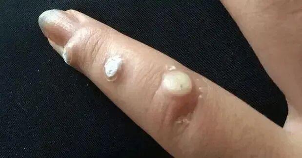 一味药就能灭了身上的瘊子、鸡眼