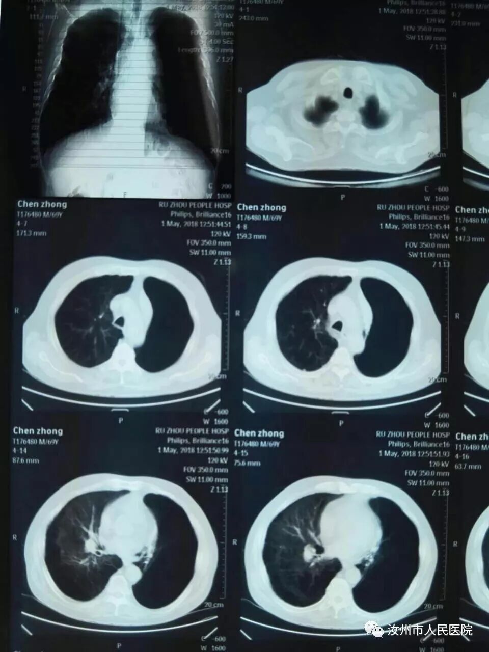 汝州市人民医院