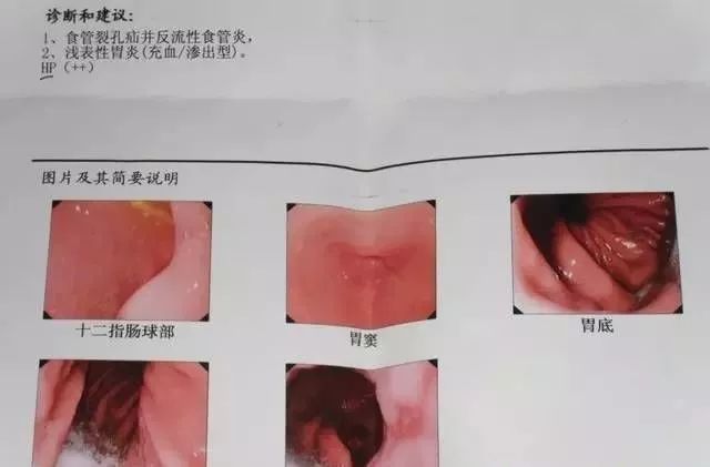 体质养生师之反流性食道炎调理 新时代健康生活家园 微信公众号文章阅读 Wemp