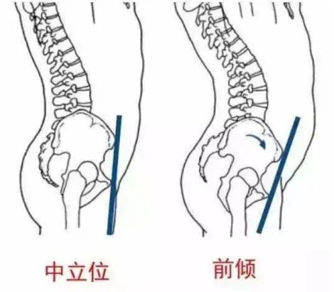 盆骨前倾与后倾到底是什么样子 该如何矫正 健身迷 微信公众号文章 微小领