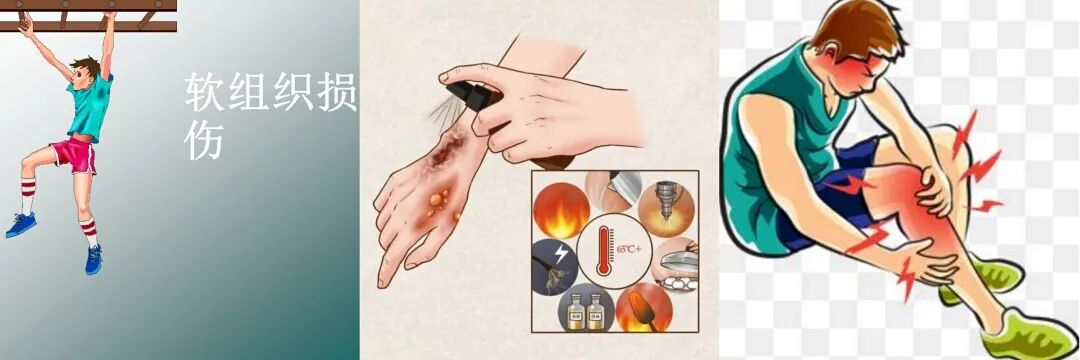 vsd引流怎么拔出VSD负压引流技术 让患者创面更快痊愈_https://www.jmylbn.com_新闻资讯_第9张