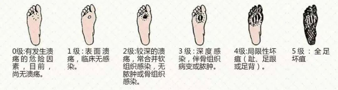 vsd引流怎么拔出VSD负压引流技术 让患者创面更快痊愈_https://www.jmylbn.com_新闻资讯_第8张