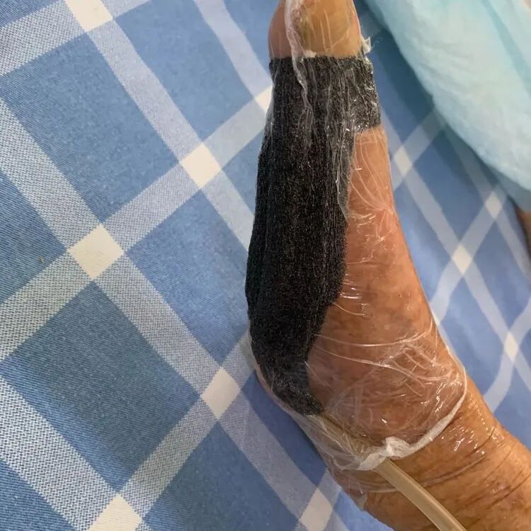 为什么负压引流VSD负压封闭引流术，让患者逃过一“截”_https://www.jmylbn.com_新闻资讯_第6张