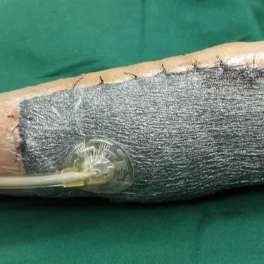 为什么负压引流VSD负压封闭引流术，让患者逃过一“截”_https://www.jmylbn.com_新闻资讯_第5张