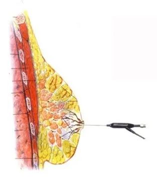 很有可能是里面乳腺导管里面长一个小瘤子了造成出血,需要做乳管镜