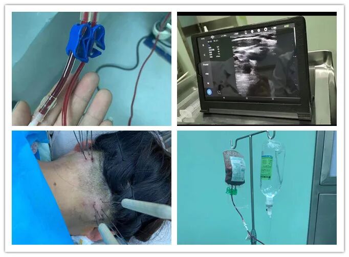 三氧疗法怎么代理【案例分享】陕西省第二人民医院疼痛科开展德国三氧治疗技术！_https://www.jmylbn.com_新闻资讯_第2张