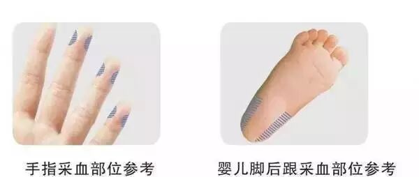 无痛采血针怎么用血糖监测扎手指真痛！无痛采血你知道吗？_https://www.jmylbn.com_新闻资讯_第22张