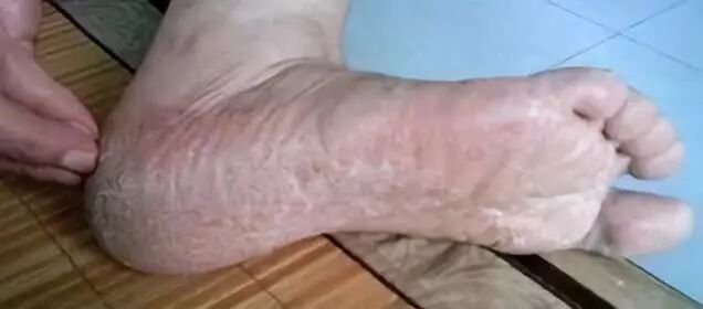 夏季最容易患上的一种皮肤病 足癣 尉氏医美中心 微信公众号文章阅读 Wemp