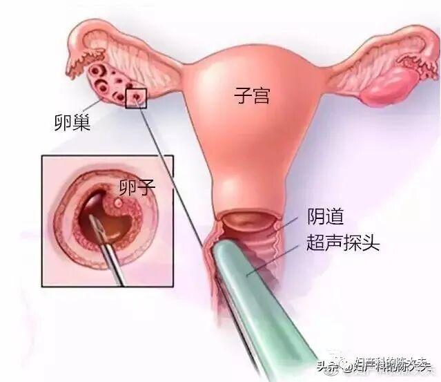 取卵针长什么样论女性试管风险有多大，恰似那近半米长的取卵针_https://www.jmylbn.com_新闻资讯_第4张