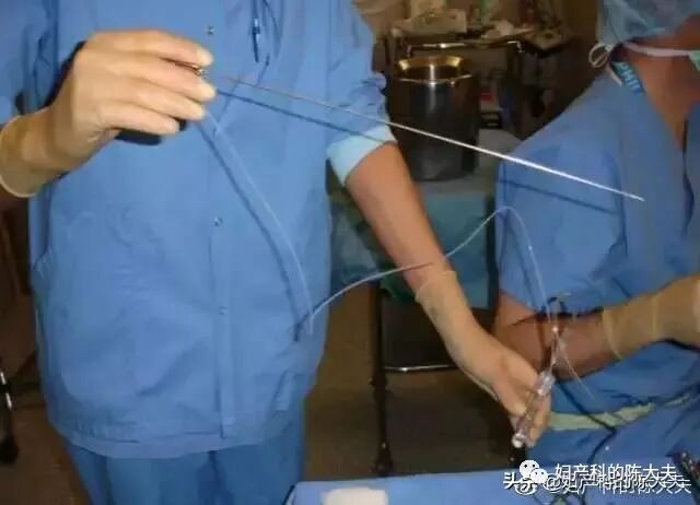 取卵针长什么样论女性试管风险有多大，恰似那近半米长的取卵针_https://www.jmylbn.com_新闻资讯_第5张