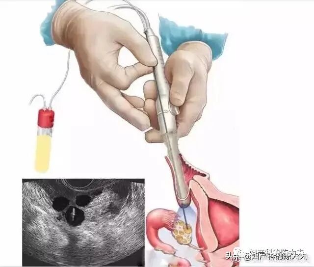 取卵针长什么样论女性试管风险有多大，恰似那近半米长的取卵针_https://www.jmylbn.com_新闻资讯_第3张