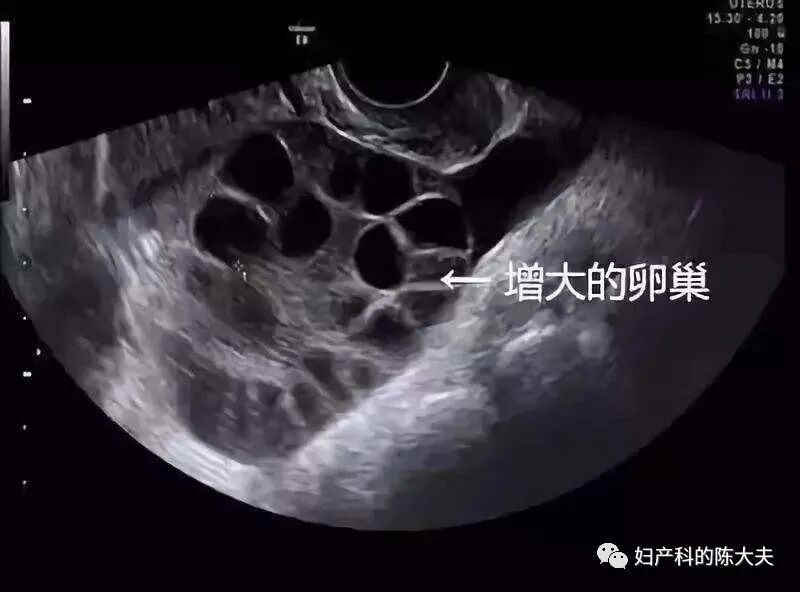 取卵针长什么样论女性试管风险有多大，恰似那近半米长的取卵针_https://www.jmylbn.com_新闻资讯_第1张