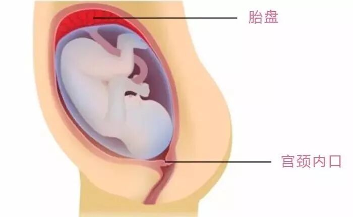 通常情况下,胎盘附着在妈妈子宫的顶部或侧面,远离宫颈内口(如下图).
