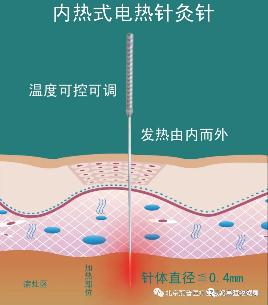 电热针灸怎么做同样是针灸发展的新形式，电热针相比其他针灸形式有哪些独特之处？_https://www.jmylbn.com_新闻资讯_第4张