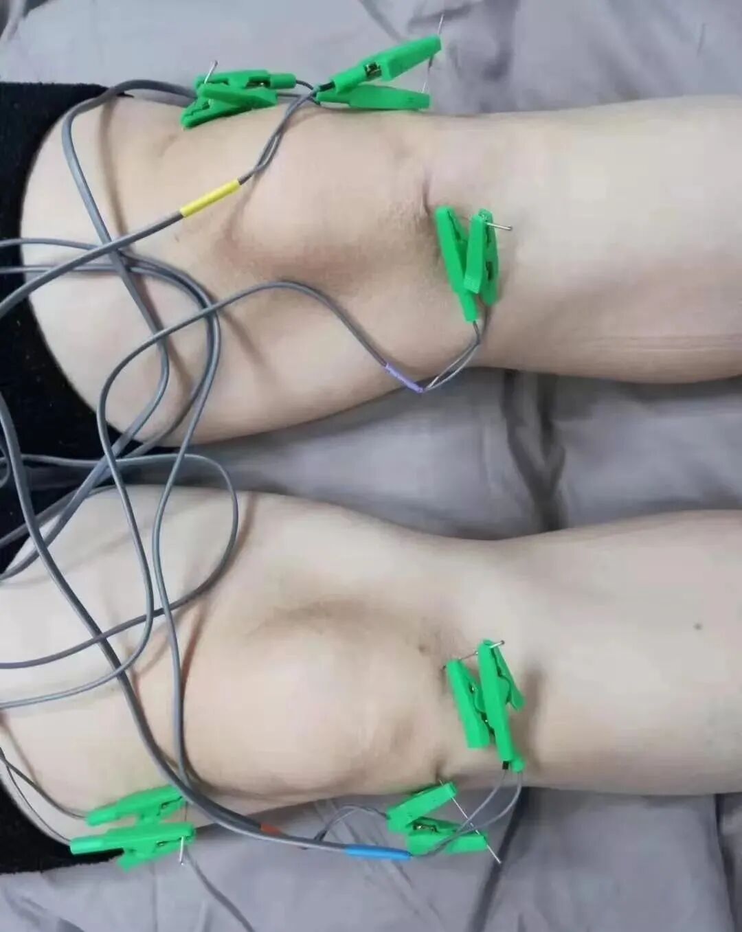 电热针灸怎么做针与灸的完美结合 ｜ “电热针”技术_https://www.jmylbn.com_新闻资讯_第9张