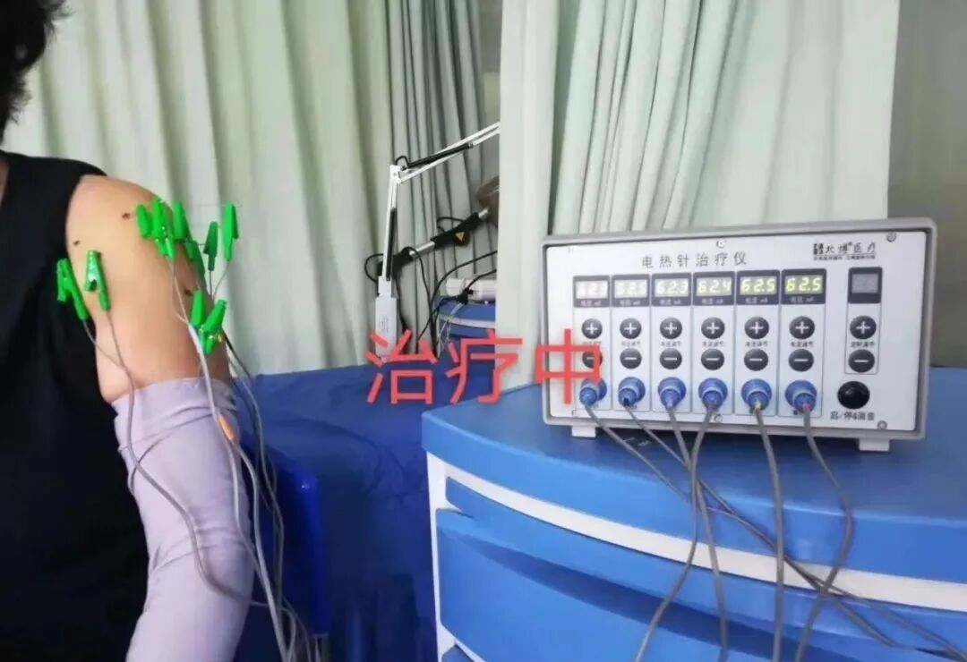 电热针灸怎么做针与灸的完美结合 ｜ “电热针”技术_https://www.jmylbn.com_新闻资讯_第10张