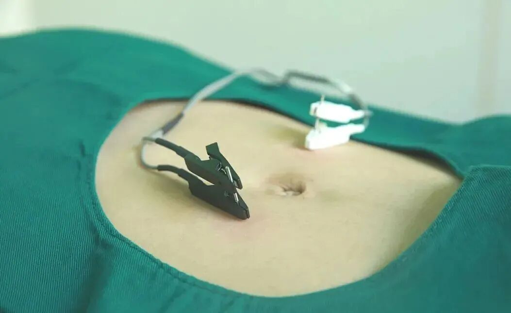 电热针灸怎么做针与灸的完美结合 ｜ “电热针”技术_https://www.jmylbn.com_新闻资讯_第4张