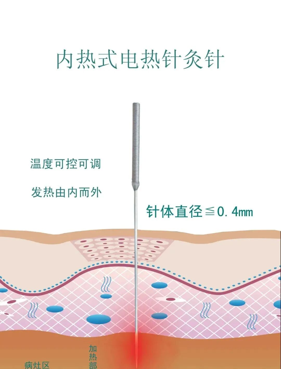 电热针灸怎么做针与灸的完美结合 ｜ “电热针”技术_https://www.jmylbn.com_新闻资讯_第8张