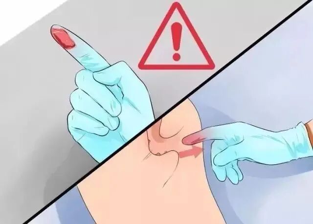 检查指套怎么弄医生是怎么通过肛门指检诊断肛肠疾病的?_新闻资讯_第7张_活检穿刺产品网 检查指套怎么弄医生是怎么通过肛门指检诊断肛肠疾病的?_https://www.jmylbn.com_新闻资讯_第7张