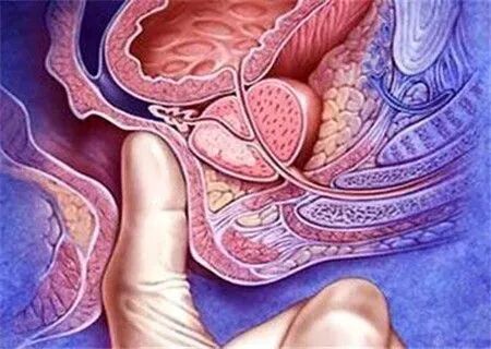 检查指套怎么弄医生是怎么通过肛门指检诊断肛肠疾病的?_新闻资讯_第1张_活检穿刺产品网 检查指套怎么弄医生是怎么通过肛门指检诊断肛肠疾病的?_https://www.jmylbn.com_新闻资讯_第1张