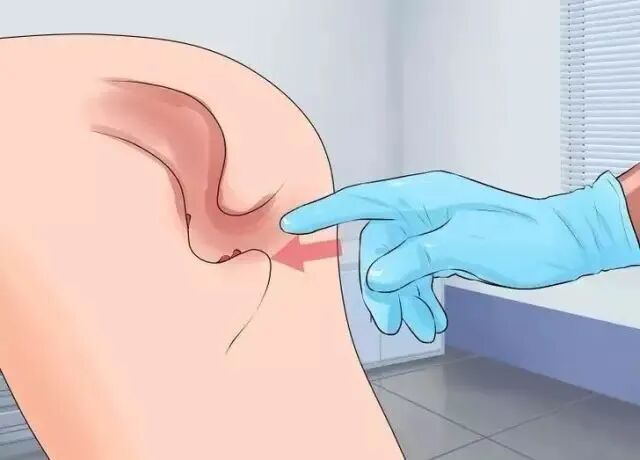 检查指套怎么弄医生是怎么通过肛门指检诊断肛肠疾病的？_https://www.jmylbn.com_新闻资讯_第5张