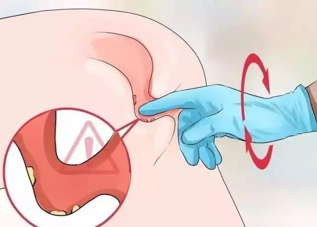 检查指套怎么弄医生是怎么通过肛门指检诊断肛肠疾病的?_新闻资讯_第6张_活检穿刺产品网 检查指套怎么弄医生是怎么通过肛门指检诊断肛肠疾病的?_https://www.jmylbn.com_新闻资讯_第6张