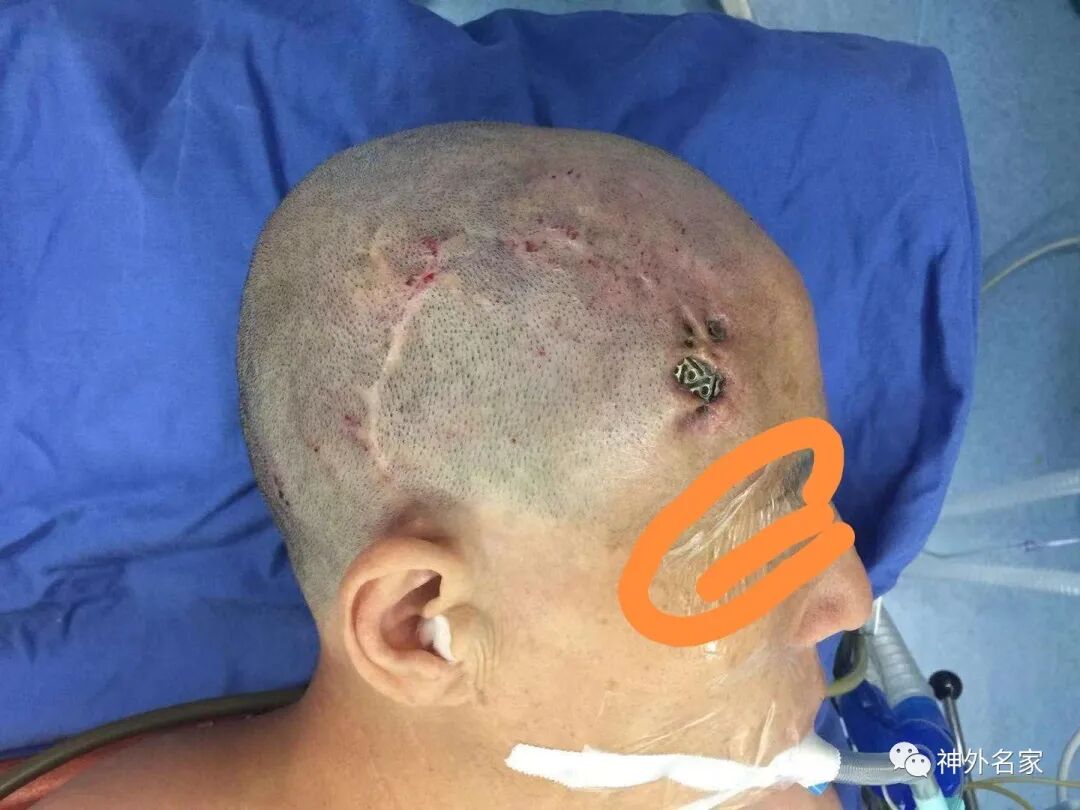 三维钛网是什么钛网外露的常见因素及如何避免钛网外露_https://www.jmylbn.com_新闻资讯_第1张