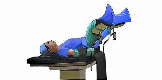 妇科手术床怎么座盘点妇产科手术需要“凹”的造型、“摆”的pose_https://www.jmylbn.com_新闻资讯_第3张