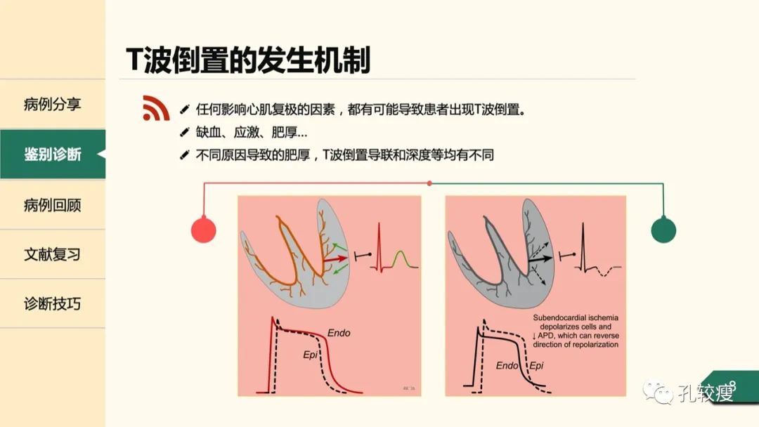 T波深倒置的鉴别诊断：从心电图到超声