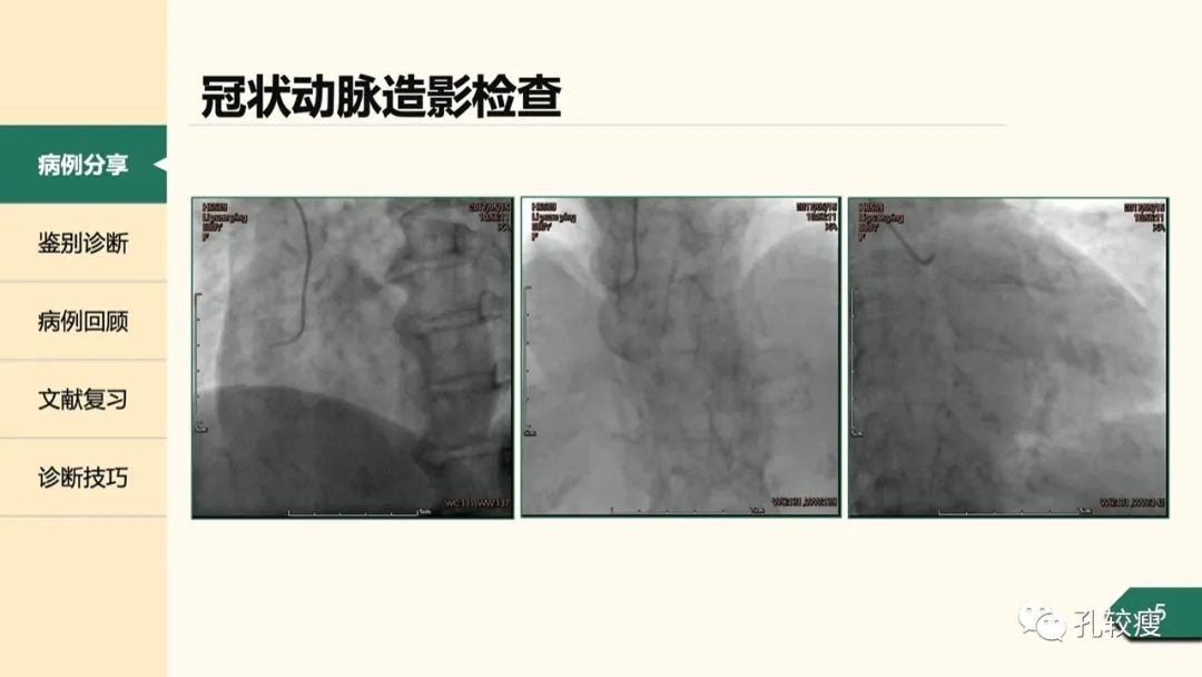 T波深倒置的鉴别诊断：从心电图到超声