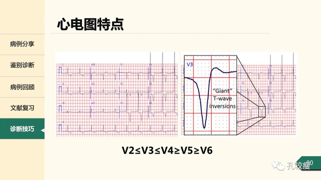 T波深倒置的鉴别诊断：从心电图到超声