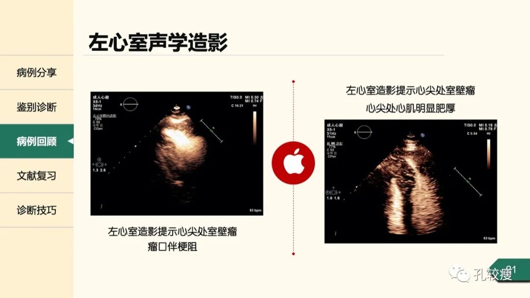 T波深倒置的鉴别诊断：从心电图到超声