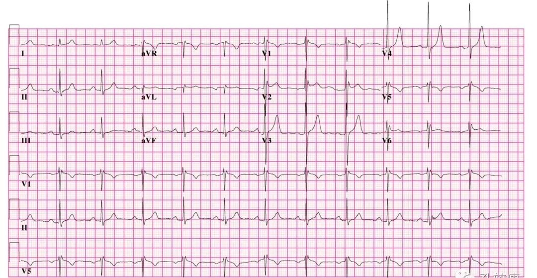 10分钟掌握Brugada综合征